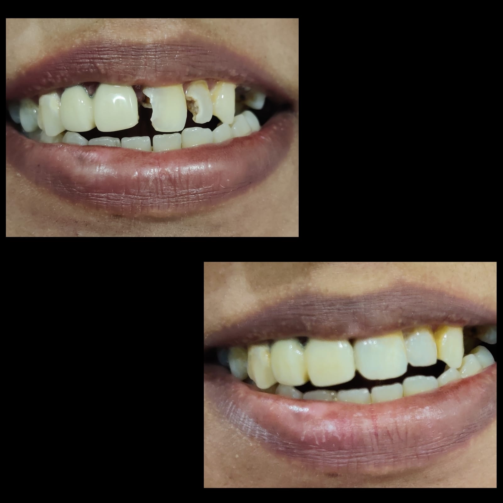 cavity cleaning and teeth whitening